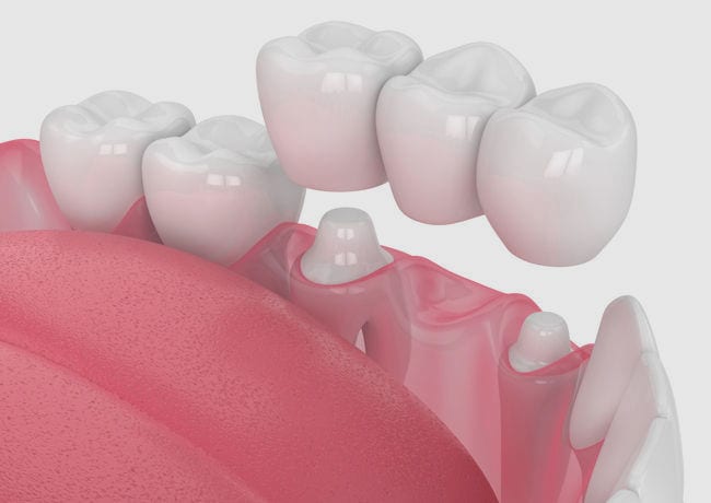 A 3D infographic shows an inside-looking-outside view of some teeth and how a dental bridge affixes to the base of teeth