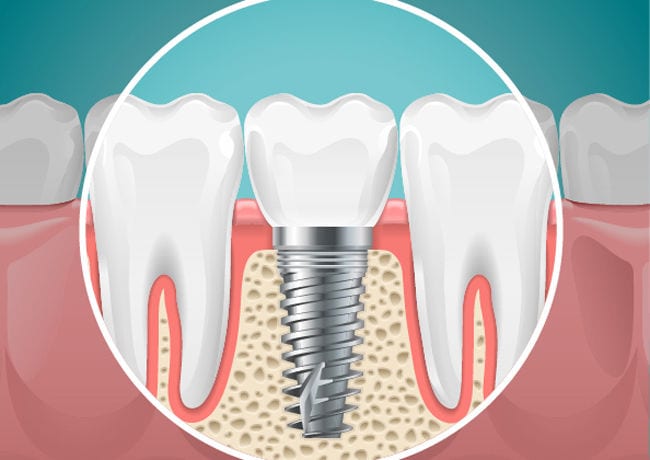 An infographic reveals the hardware and structure of a dental implant below the teeth and gumline.