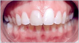Closeup of a patient's mouth reveals an overbite, some discoloration in the teeth, and receding gums.