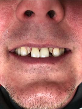 Before having crowns implanted, a crowded smile is shown off where the neighbors to the two front teeth will be capped.