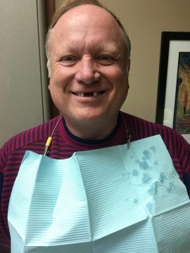 image0 A man with missing teeth smiles to reveal the spaces where teeth should be
