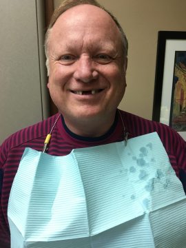 A man with missing teeth smiles to reveal the spaces where teeth should be
